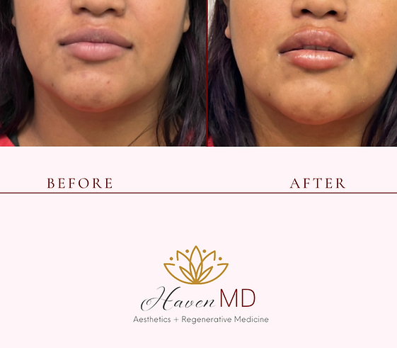 After & Before Neogen Plasma Treatment