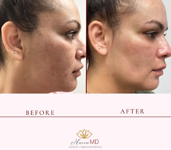After & Before Neogen Plasma Treatment