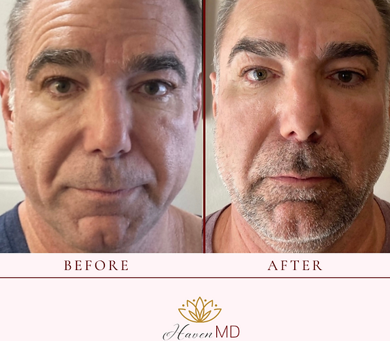 After & Before Neogen Plasma Treatment