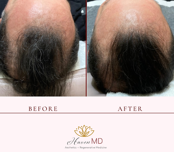 After & Before Neogen Plasma Treatment