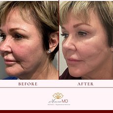 After & Before Neogen Plasma Treatment