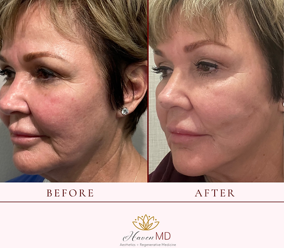 After & Before Neogen Plasma Treatment