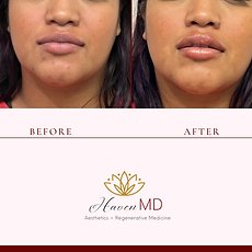 After & Before Fillers