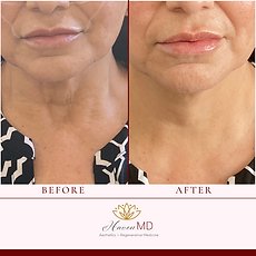 After & Before Fillers