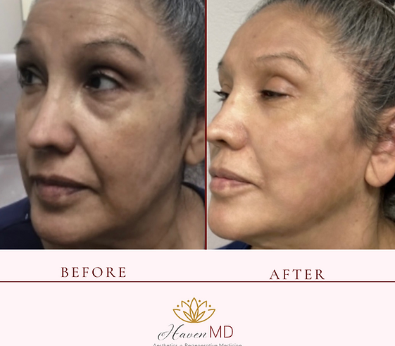 After & Before Neogen Plasma Treatment