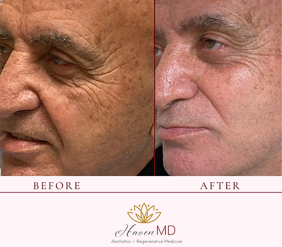 After & Before Neogen Plasma Treatment