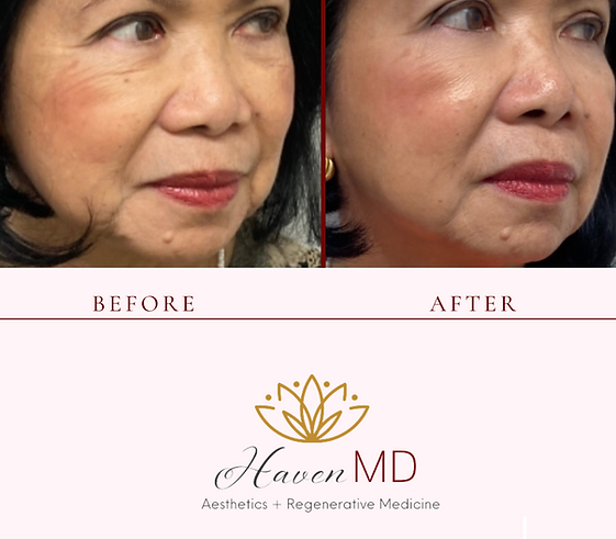 After & Before Neogen Plasma Treatment