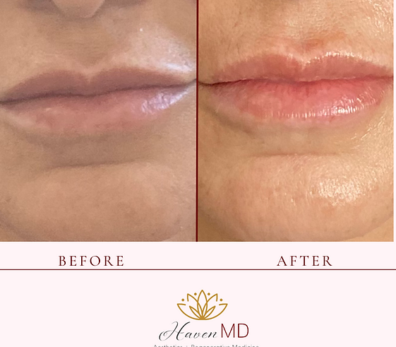 After & Before Fillers