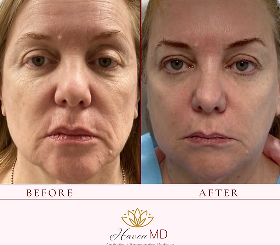 After & Before Neogen Plasma Treatment