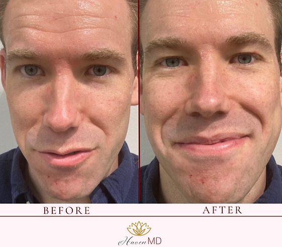 After & Before Botox Treatment
