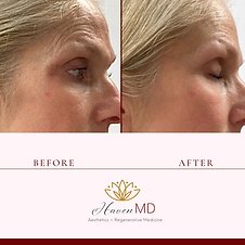 After & Before Botox Treatment