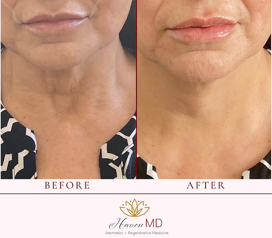 After & Before Neogen Plasma Treatment