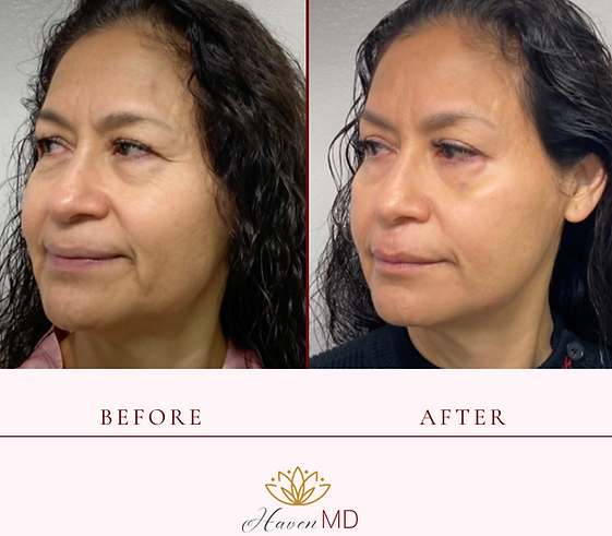 After & Before Neogen Plasma Treatment