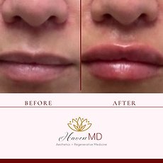After & Before Fillers