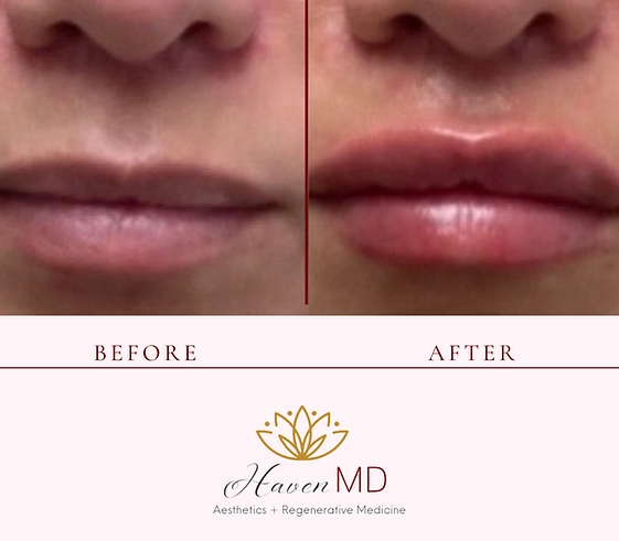 After & Before Fillers