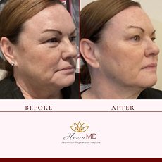 After & Before Neogen Procedure