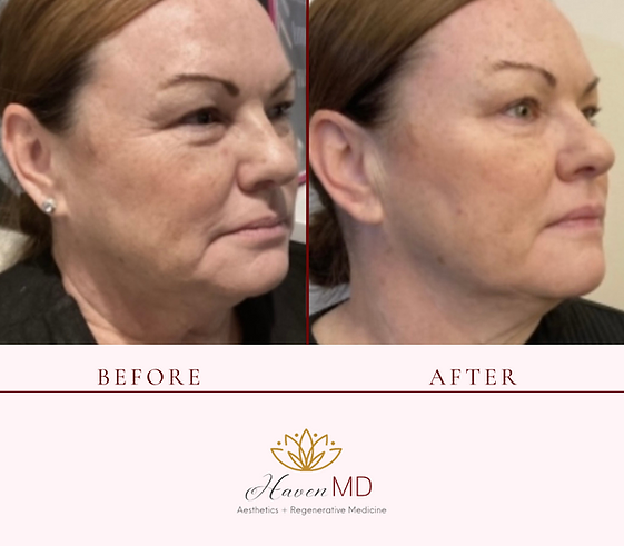 After & Before Neogen Plasma Treatment