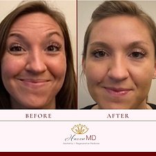 After & Before Botox Treatment