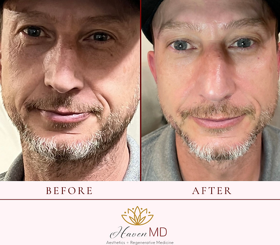 After & Before Neogen Plasma Treatment