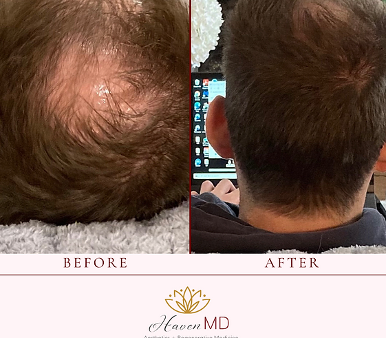 PRP Injections for Hair loss