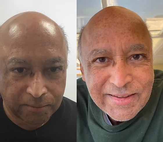 PRP Injections for Hair loss