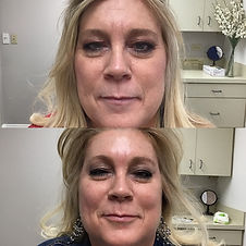After & Before Botox Treatment