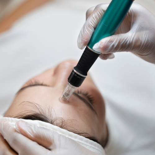 MICRONEEDLING